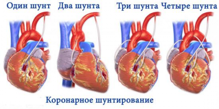 шунтирование