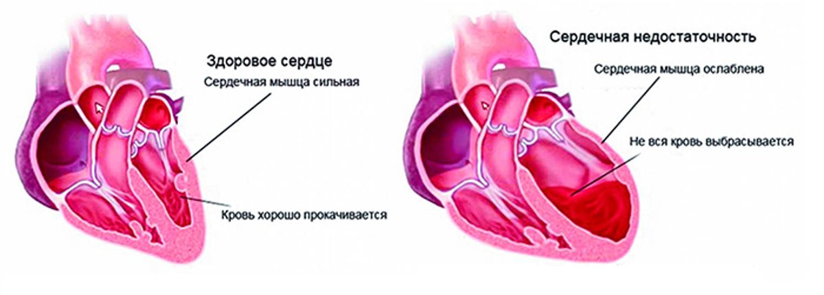 сердечная недостаточность