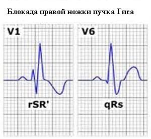 Блокада ножек пучка Гиса