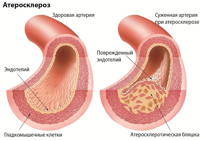 Развитие атеросклероза