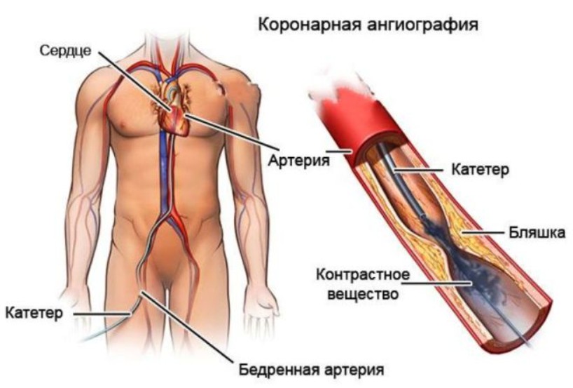 Коронография сердца. Препараты, риски