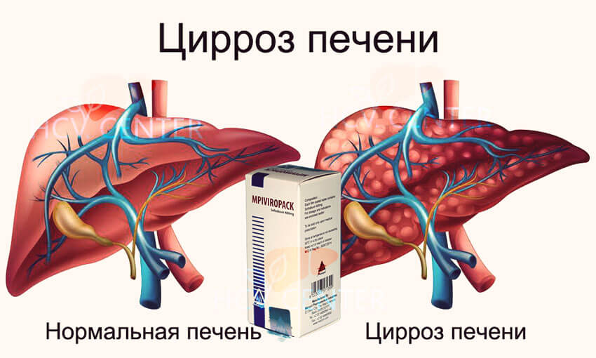 Лечение гепатита сегодня